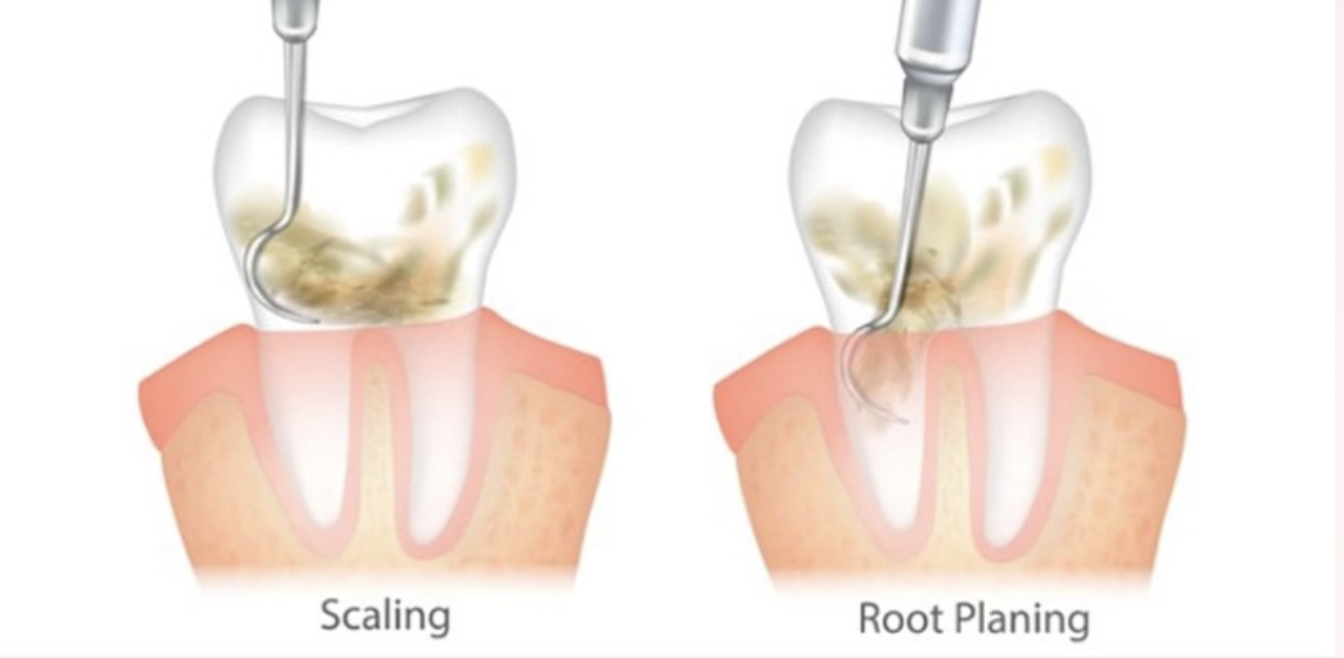 Educational comparison of scaling and root planing beneath the gumline Educational comparison of scaling and root planing beneath the gumline