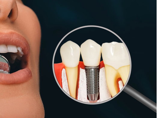 dental implants in milpitas