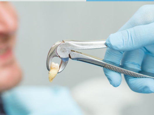 dental extraction in milpitas dental extraction in milpitas