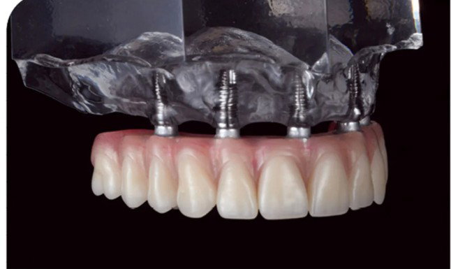 Hybrid Dentures (Fixed) Hybrid Dentures (Fixed)