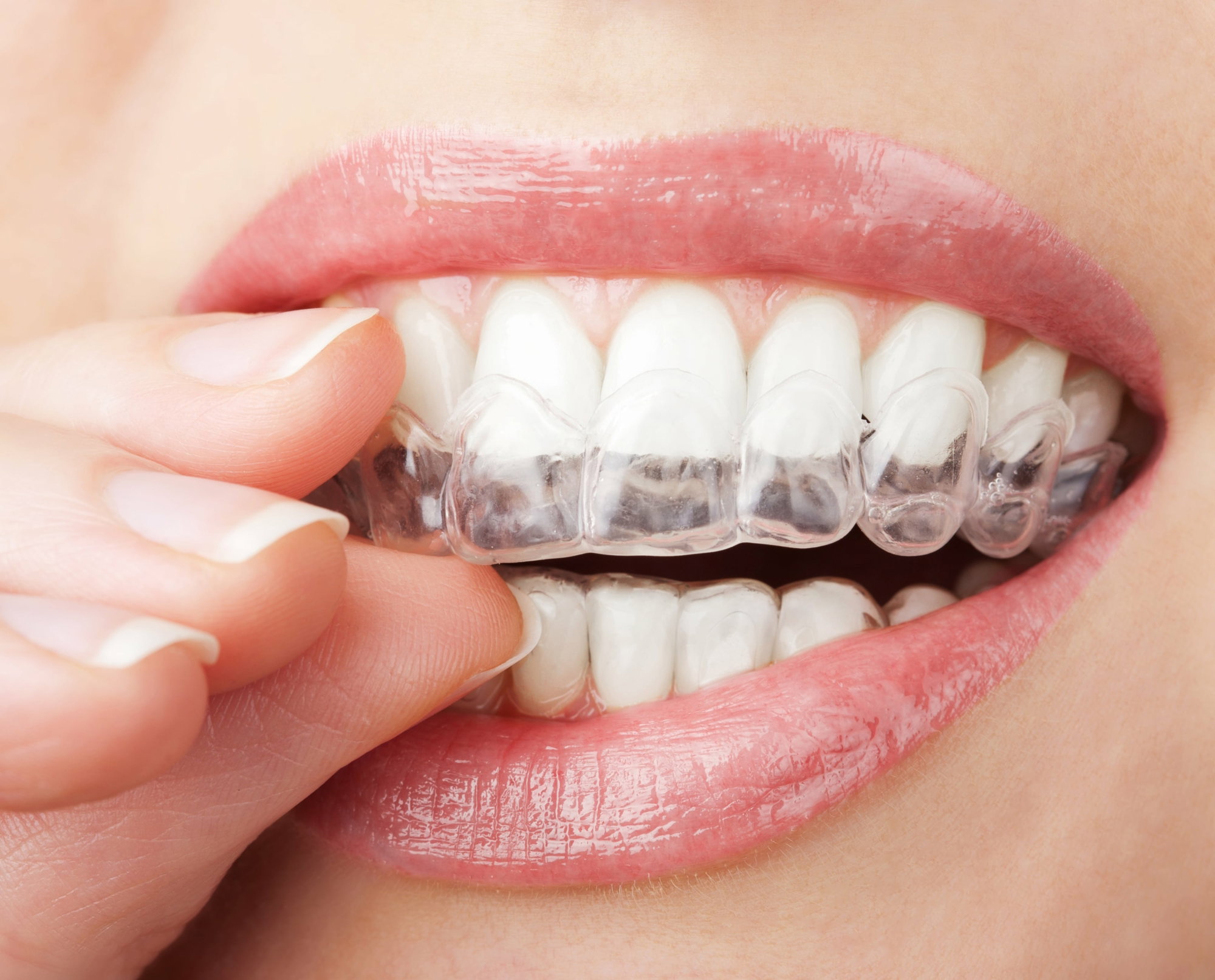 Invisalign treatment