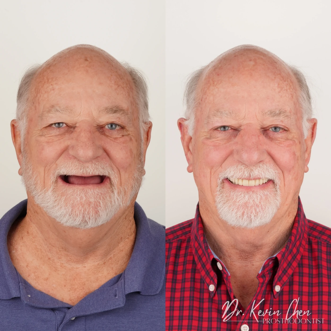 Supplied facial comparison for Dr. Chen’s from removable dentures to fixed implant-supported teeth case Supplied facial comparison for Dr. Chen’s from removable dentures to fixed implant-supported teeth case