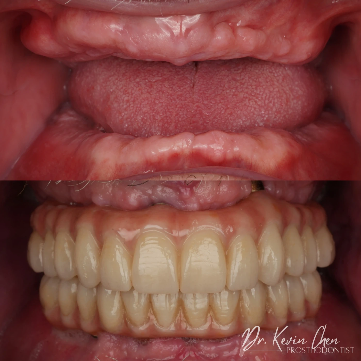 Supplied dental comparison for Dr. Chen’s from removable dentures to fixed implant-supported teeth case Supplied dental comparison for Dr. Chen’s from removable dentures to fixed implant-supported teeth case