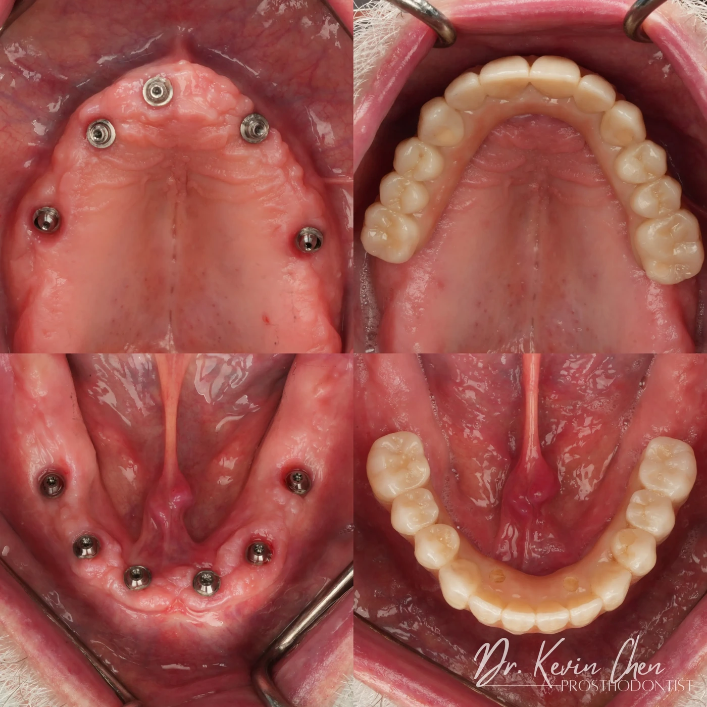 Supplied dental comparison for Dr. Chen’s from removable dentures to fixed implant-supported teeth case Supplied dental comparison for Dr. Chen’s from removable dentures to fixed implant-supported teeth case