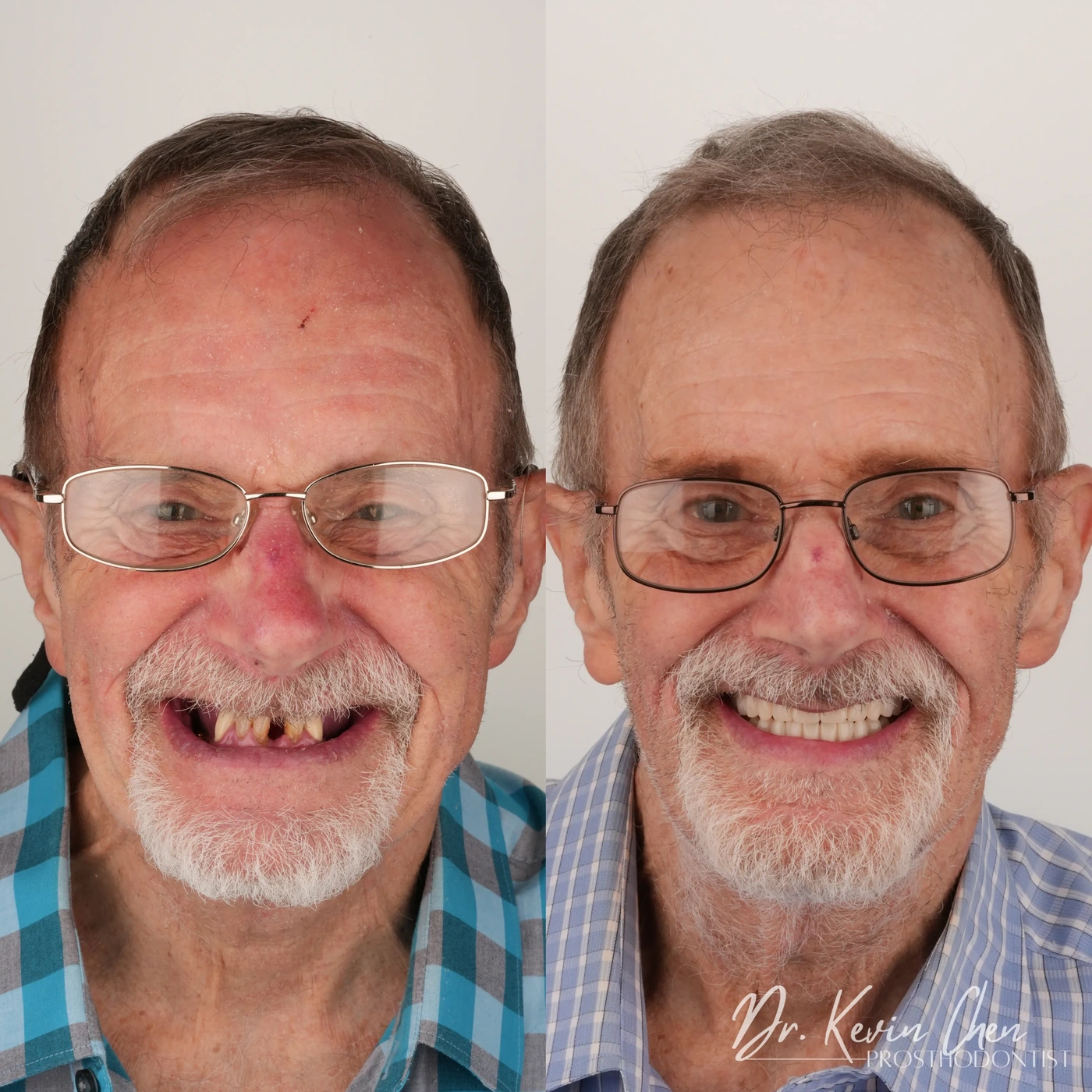 Supplied facial comparison for Dr. Chen’s a new smile with implant-retained dentures case Supplied facial comparison for Dr. Chen’s a new smile with implant-retained dentures case