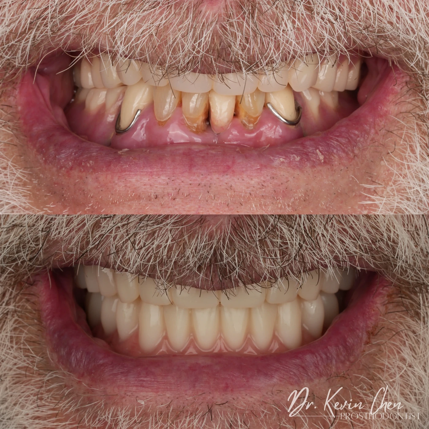Supplied dental comparison for Dr. Chen’s a new smile with implant-retained dentures case Supplied dental comparison for Dr. Chen’s a new smile with implant-retained dentures case