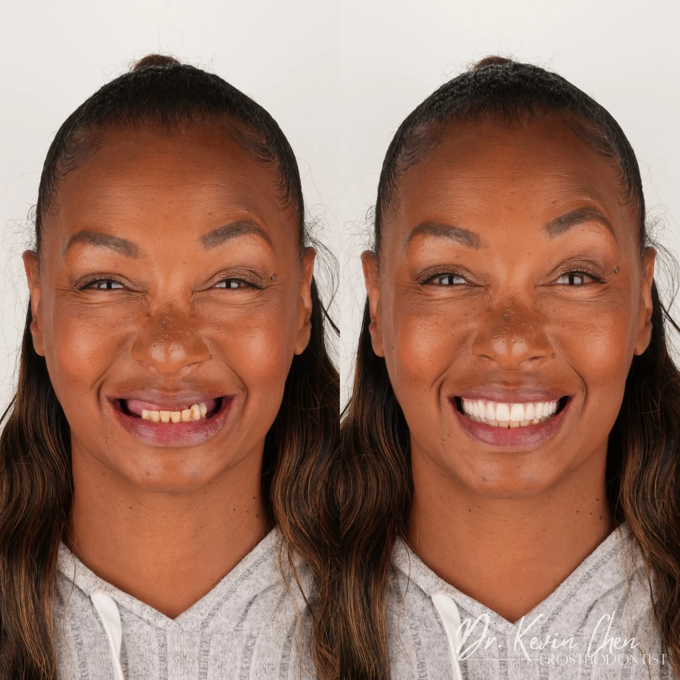 Supplied facial comparison for Dr. Chen’s a beautiful smile—without dental implants case Supplied facial comparison for Dr. Chen’s a beautiful smile—without dental implants case
