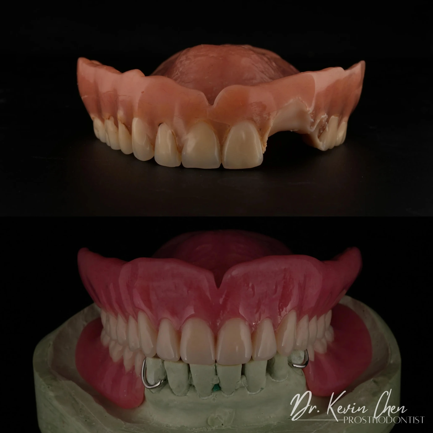 Supplied dental comparison for Dr. Chen’s a beautiful smile—without dental implants case Supplied dental comparison for Dr. Chen’s a beautiful smile—without dental implants case