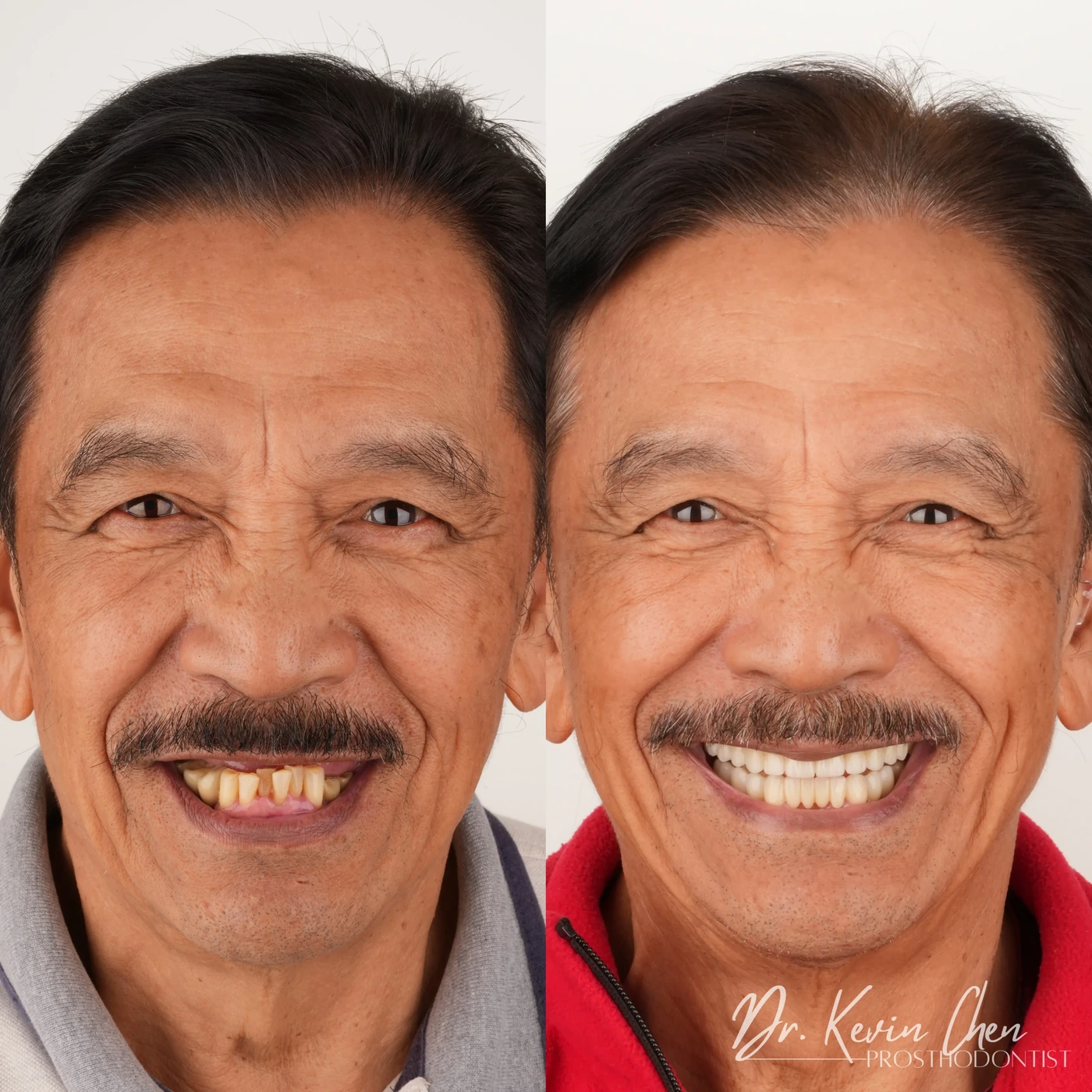 Supplied facial comparison for Dr. Chen’s rebuilding a smile after failing dental work case Supplied facial comparison for Dr. Chen’s rebuilding a smile after failing dental work case