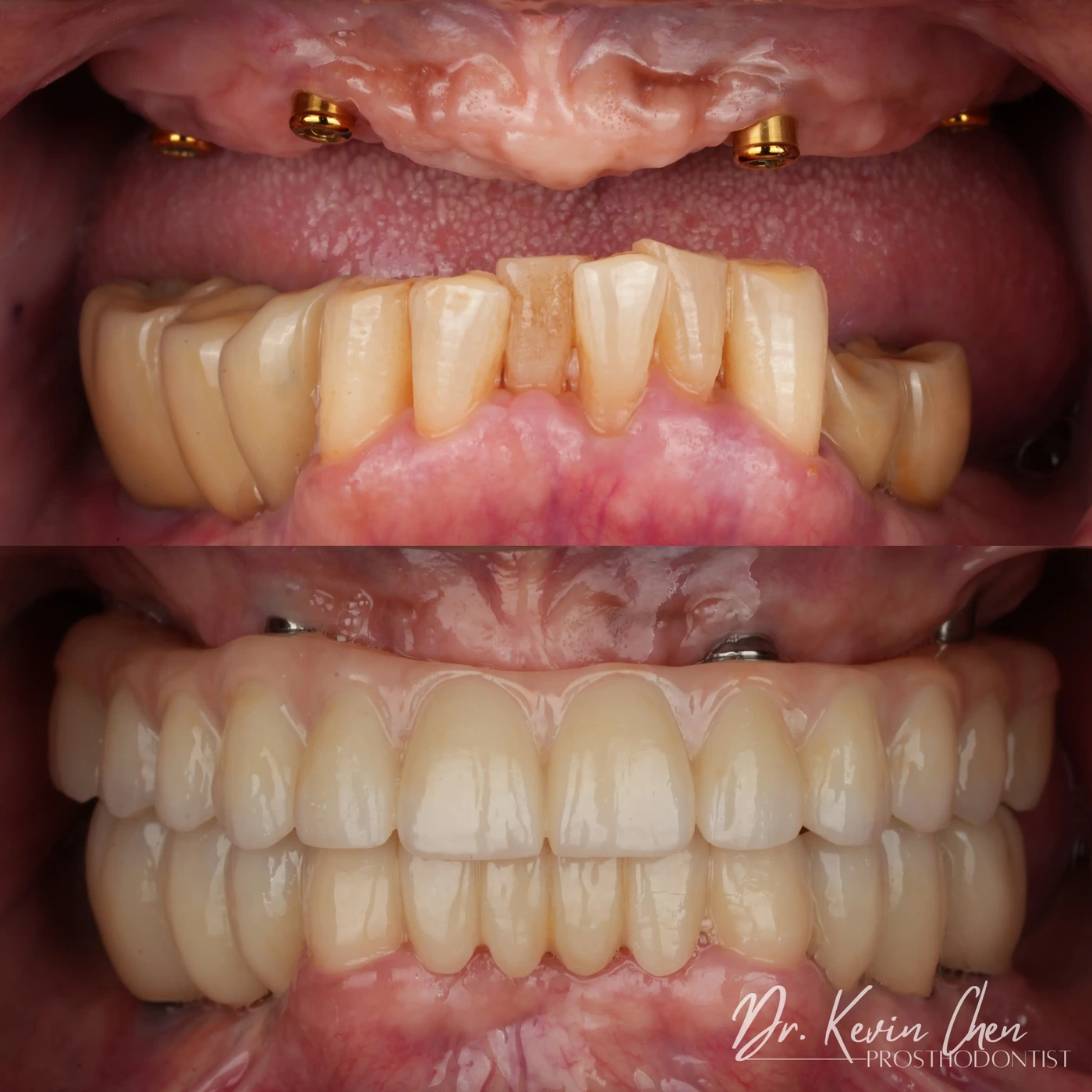 Supplied dental comparison for Dr. Chen’s rebuilding a smile after failing dental work case Supplied dental comparison for Dr. Chen’s rebuilding a smile after failing dental work case