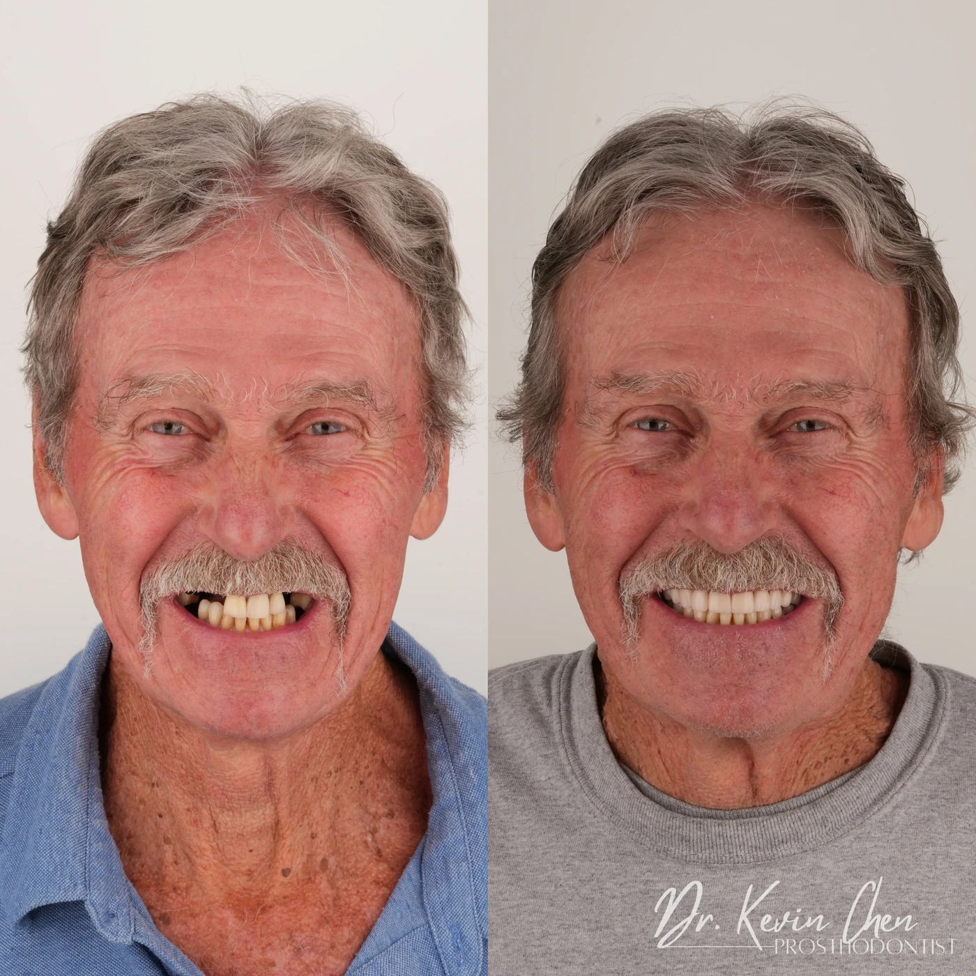 Supplied facial comparison for Dr. Chen’s restoring function after multiple missing teeth case Supplied facial comparison for Dr. Chen’s restoring function after multiple missing teeth case