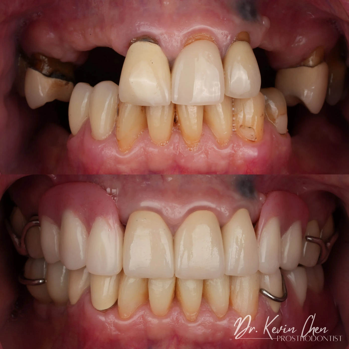 Supplied dental comparison for Dr. Chen’s restoring function after multiple missing teeth case Supplied dental comparison for Dr. Chen’s restoring function after multiple missing teeth case