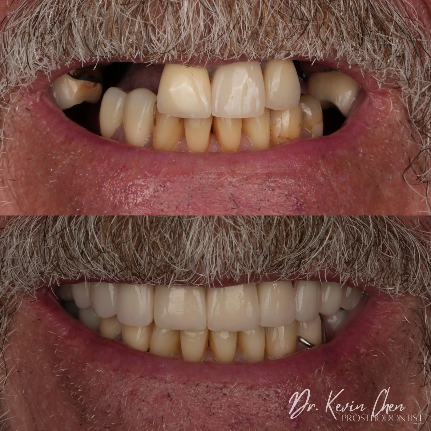 Supplied dental comparison for Dr. Chen’s restoring function after multiple missing teeth case Supplied dental comparison for Dr. Chen’s restoring function after multiple missing teeth case
