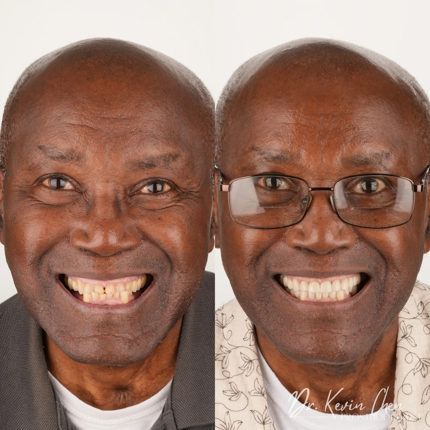 Supplied facial comparison for Dr. Chen’s rebuilding a bite damaged by severe tooth erosion case Supplied facial comparison for Dr. Chen’s rebuilding a bite damaged by severe tooth erosion case