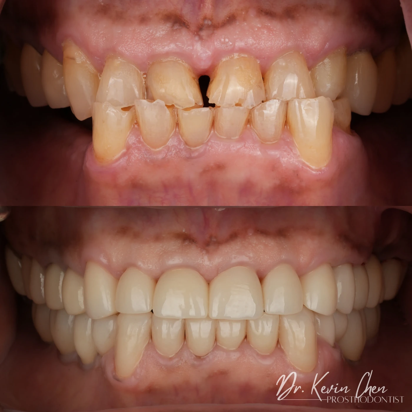Supplied dental comparison for Dr. Chen’s rebuilding a bite damaged by severe tooth erosion case Supplied dental comparison for Dr. Chen’s rebuilding a bite damaged by severe tooth erosion case