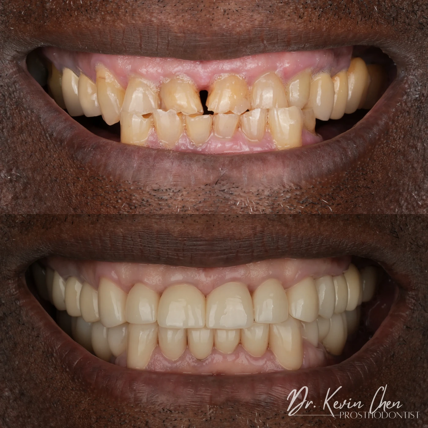 Supplied dental comparison for Dr. Chen’s rebuilding a bite damaged by severe tooth erosion case Supplied dental comparison for Dr. Chen’s rebuilding a bite damaged by severe tooth erosion case