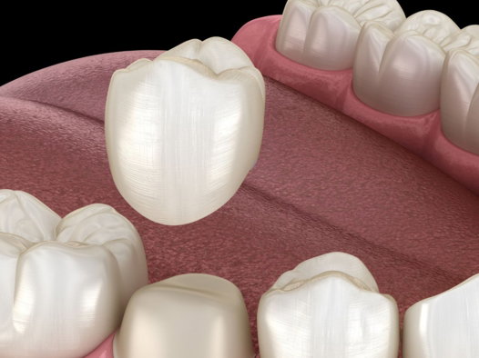dental crowns in milpitas dental crowns in milpitas
