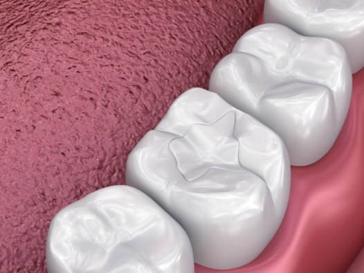 ceramic dental fillings ceramic dental fillings
