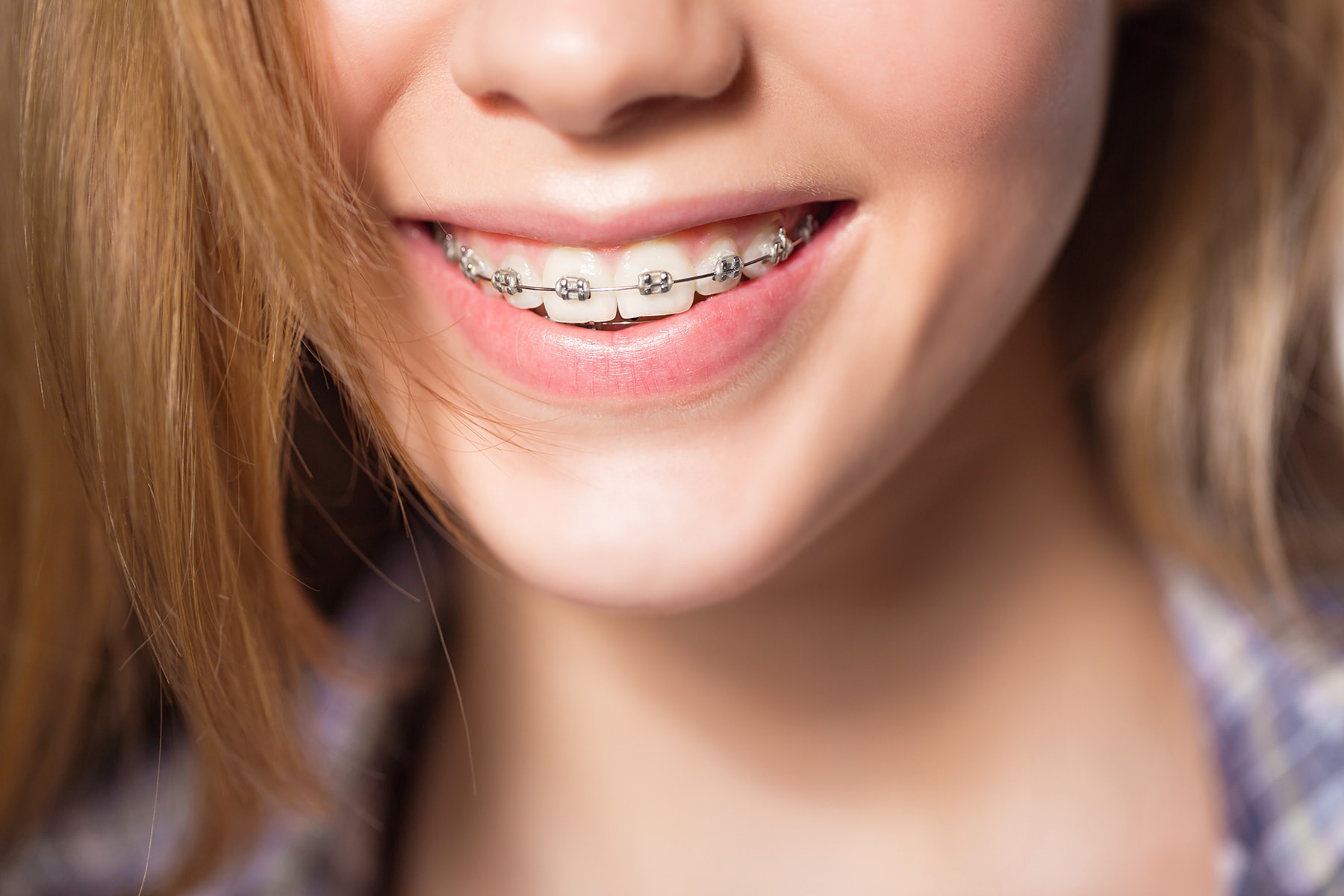 Numerous types of braces