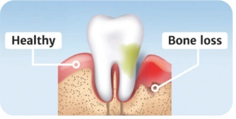 Educational comparison: Healthy and Bone loss Educational comparison: Healthy and Bone loss
