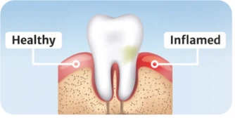 Educational comparison: Healthy and Inflamed Educational comparison: Healthy and Inflamed