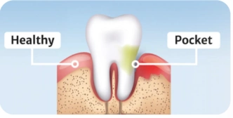 Educational comparison: Healthy and Pocket Educational comparison: Healthy and Pocket