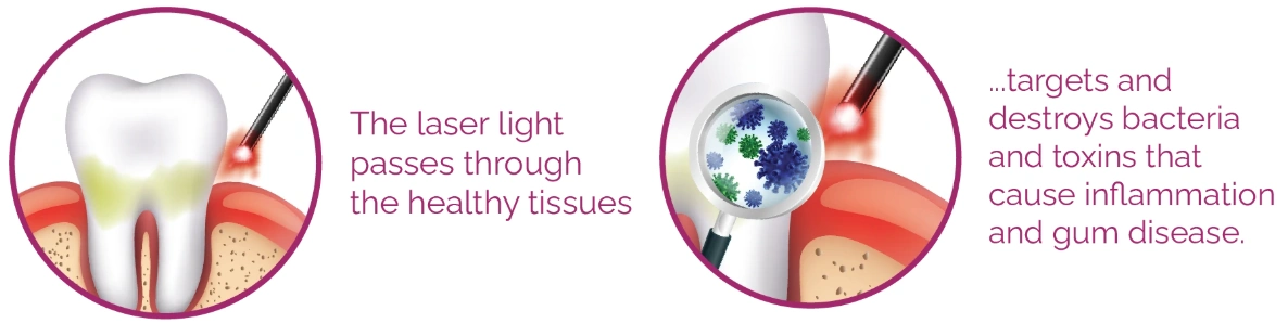 Educational laser illustrations: healthy tissue and bacterial reduction Educational laser illustrations: healthy tissue and bacterial reduction