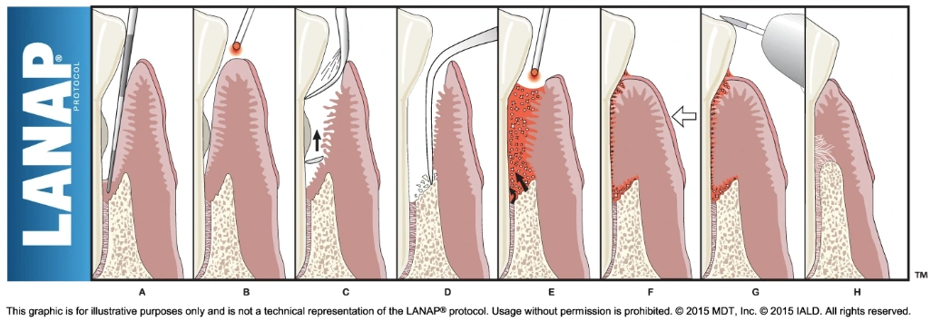 Educational LANAP laser gum treatment protocol, panels A through H Educational LANAP laser gum treatment protocol, panels A through H