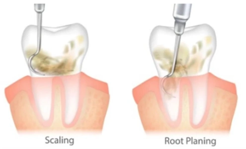 Scaling and root planing beneath the gumline Scaling and root planing beneath the gumline