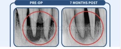 Example 1 · 7 months follow-up; supplied Millennium Dental Technologies X-ray comparison Example 1 · 7 months follow-up; supplied Millennium Dental Technologies X-ray comparison