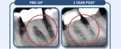 Example 2 · 1 year follow-up; supplied Millennium Dental Technologies X-ray comparison Example 2 · 1 year follow-up; supplied Millennium Dental Technologies X-ray comparison