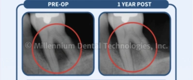 Example 3 · 1 year follow-up; supplied Millennium Dental Technologies X-ray comparison Example 3 · 1 year follow-up; supplied Millennium Dental Technologies X-ray comparison